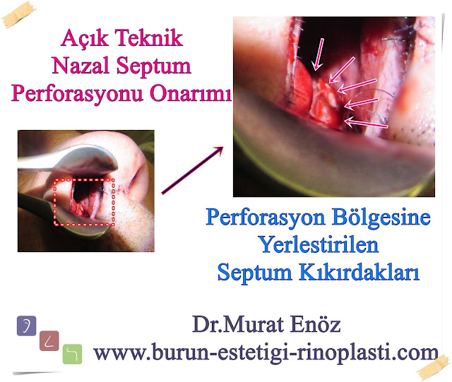 Septum perforasyonu tanımı - Septum perforasyonu  nedenleri - Septum perforasyonu belirtileri - Septum perforasyonu tedavisi - Açık teknik septum perforasyonu ameliyatı - Açık teknik septum perforasyonu onarımı - Burun duvarında delik