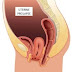 Sample Nursing Care Plan for Uterine Prolapse (Post Operative)