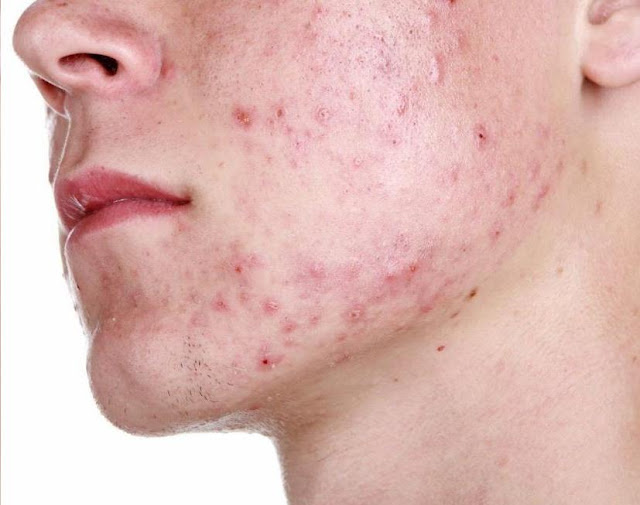 Home Remedies Chickenpox Disease and Facts