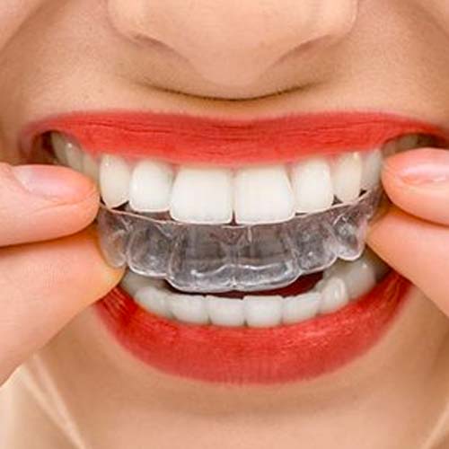Est-ce que l'orthodontie invisible donne vraiment le résultat escompté ?