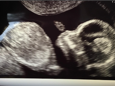 ultrasound-photo-of-blac-chyna's-baby-with-rob-kardashian