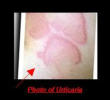 Urticaria Picture