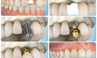 Cấu tại của răng Implant ra sao?