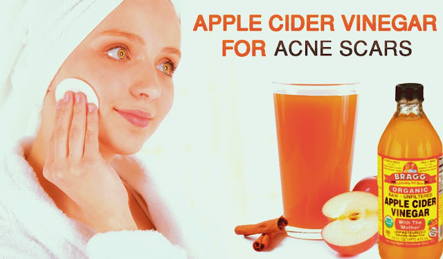 apple cider vinefer for acne