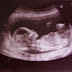 Καρδίτσα: Αφαιρέθηκε από 10χρονη "έμβρυο" που δεν είχε αναπτυχθεί
