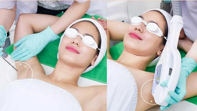 hair-removal-treatment-zap