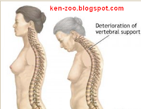 Mengenal Tentang Osteoporosis Dan Pengobatannya