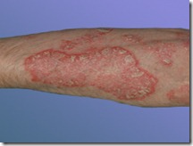 psoriasis1