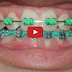 The Effects of Wearing Braces - You Will Be Amazed!