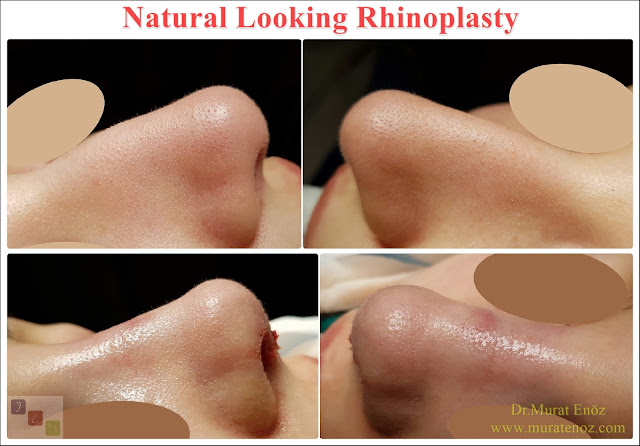 Natural Looking Rhinoplasty - Natural Nose Job - Natural Rhinoplasty - Female Nose Aesthetic Surgery - Nose Jobs For Women - Nose Reshaping for Women - Best Rhinoplasty For Women Istanbul - Female Rhinoplasty Istanbul - Nose Job Surgery for Women - Women's Rhinoplasty - Nose Aesthetic Surgery For Women - Female Rhinoplasty Surgery in Istanbul - Female Rhinoplasty Surgery in Turkey