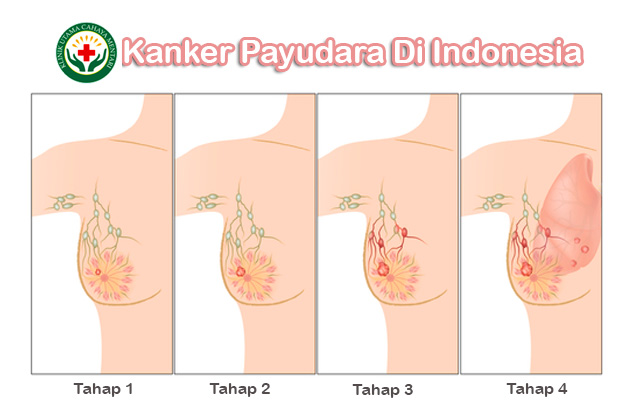 Klinik Pengobatan Kanker Payudara Di Indonesia