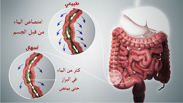 أسباب الإسهال المتكرر , وطريقة العلاج منزليا ومتا يكون الاسهال خطيرا . ما هي اسباب الاسهال المتكرر عند الكبار اسباب الاسهال المتكرر عند الاطفال علاج الاسهال المستمر اسباب الاسهال المفاجئ اسهال شديد كالماء .