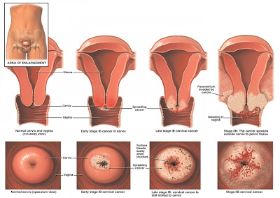 Cervical Cancer in Women