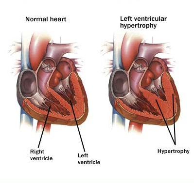Left Ventricular Hypertrophy found in Hipertensive Heart Disease