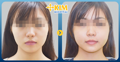 Trước và sau khi hạ gò má tại KIM Hospital.