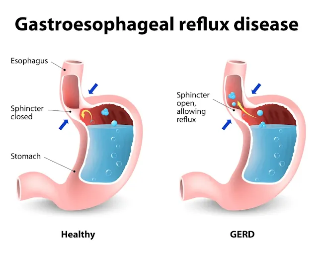 Makanan untuk Pesakit GERD: Ketahui Beza GERD dan Gastrik