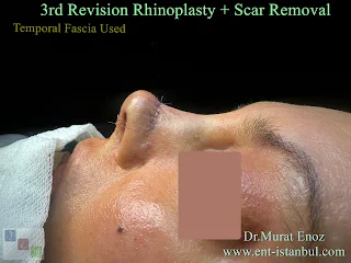 revision rhinoplasty, scar removal, complex surgery, nasal reconstruction, secondary rhinoplasty, plastic surgery, nasal aesthetics, surgical revision, rhinoplasty techniques, scar treatment, nose job revision, nasal anatomy, facial plastic surgery, surgical scars, aesthetic surgery, cosmetic enhancement, rhinoplasty recovery, nasal deformity, corrective surgery, scar management