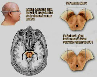 penyebab penyakit parkinson