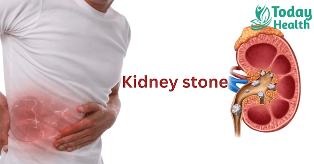 Medicine for kidney stone in hindi