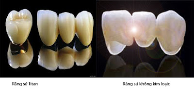 Bọc răng sứ Titan có ưu điểm gì?
