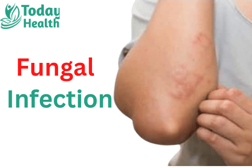 Fungal infection in hindi
