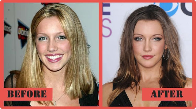 Katie Cassidy Plastic Surgery Before After