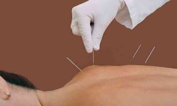 Types of Acupuncture.