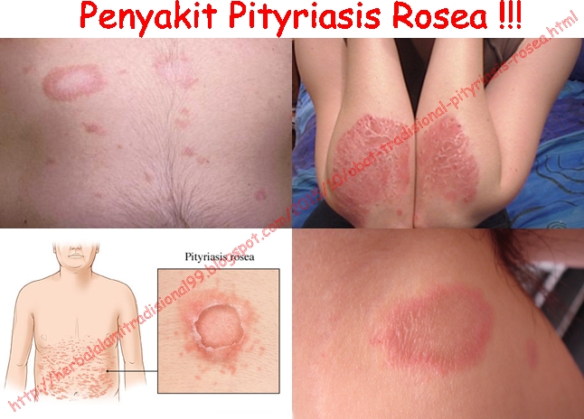 Obat Tradisional Pityriasis Rosea