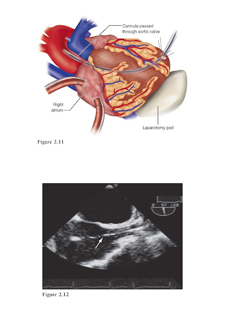 Transapical Cannulation