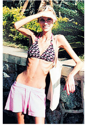 anorexia, anorexic, bride, Laura Wilson