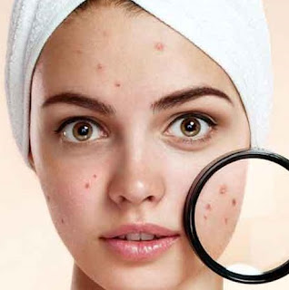 How To Remove Acne Scars With Natural Materials