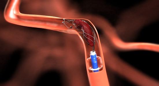 Intracranial Stents