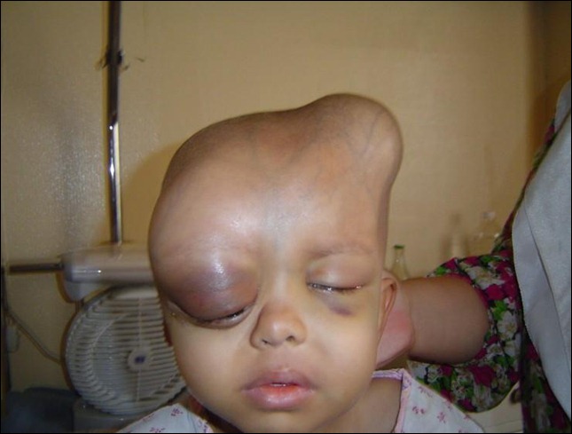 Deformed child