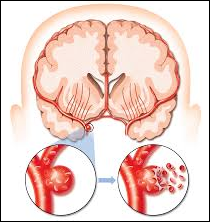Stroke Infark