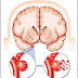 Stroke Infark dan Patofisiologi Stroke Infark