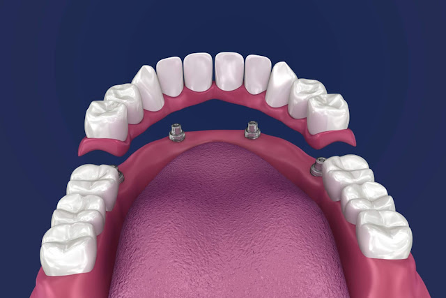 When Is It the Right Time to Get Dental Implants?