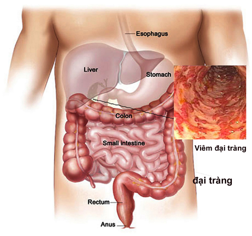 triệu chứng đau dạ dày tá tràng