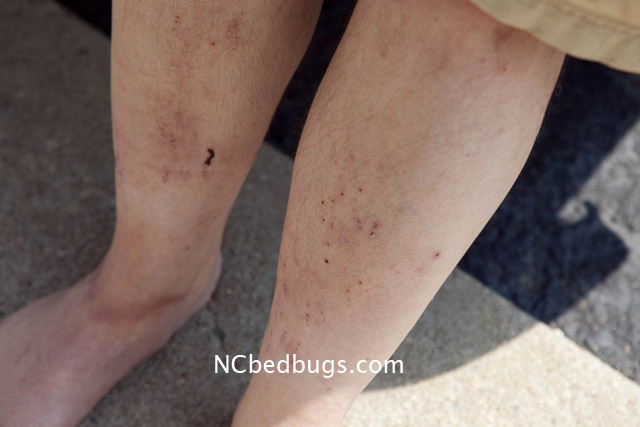 Download image Infected Bed Bug Bites PC, Android, iPhone and iPad ...