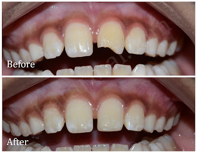 Chipped Tooth Repaired with Cosmetic Composite Filling
