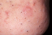 Komedo Terbuka atau Blackhead