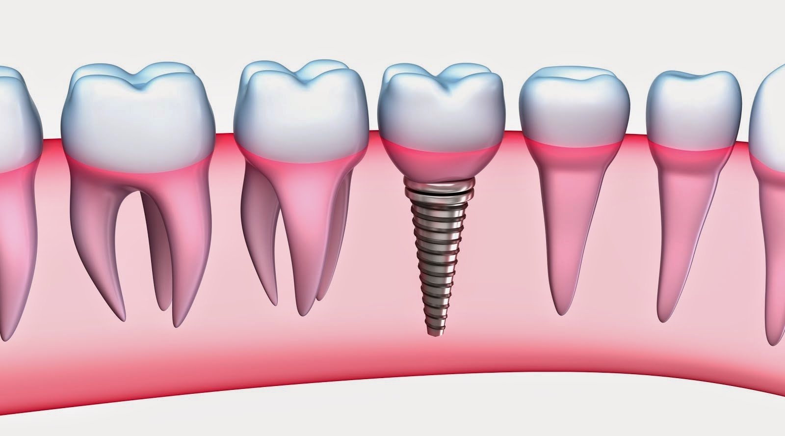 Dental Implants