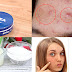 How To Remove Acne, Pimples, Dark Spots And Scars Within 2 Days With This Cream!