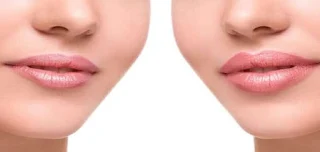 تكبير الشفايف والخدود طبيعيًا