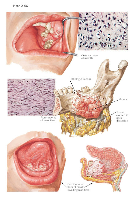 Malignant Tumors of Jaw