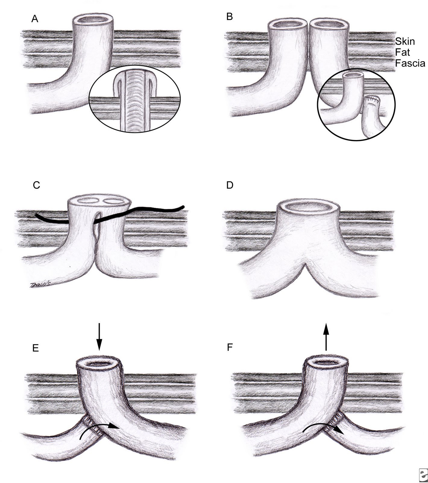 stoma