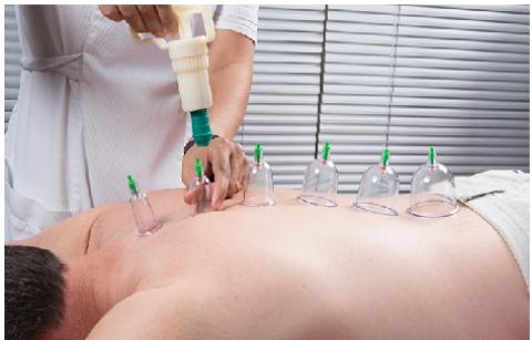 Benefits of cupping (Hijama)