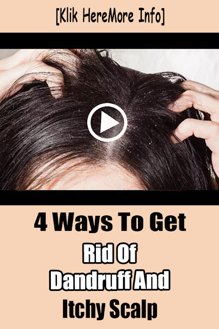 4 Ways To Get Rid Of Dandruff And Itchy Scalp
