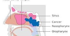  Apa  itu Kanker Nasofaring Gejala Penyebab dan Cara 