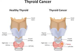 What Is Thyroid Cancer