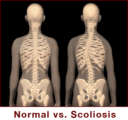Scoliosis Treatment in Singapore